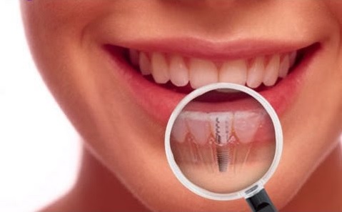 Dental Implants NJ