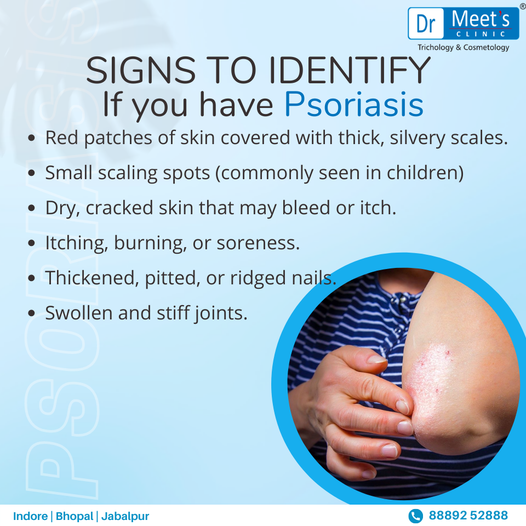 psoriasis treatment in indore